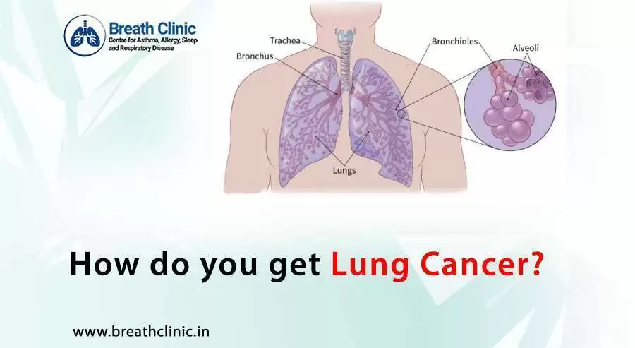 Lung Cancer