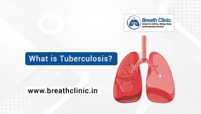 Tuberculosis