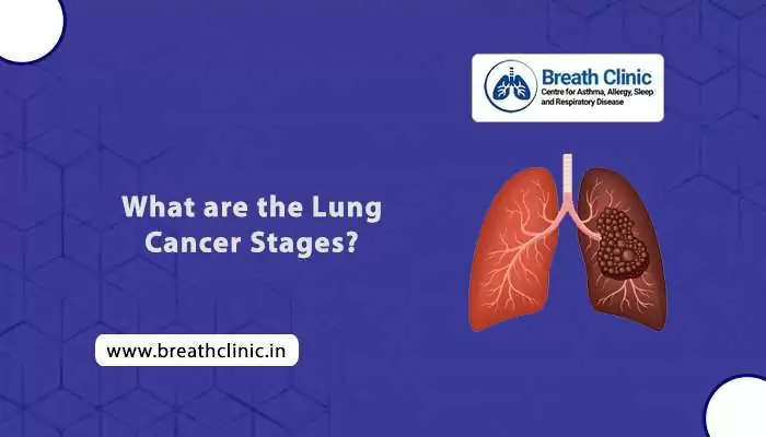 Stages of Lung Cancer