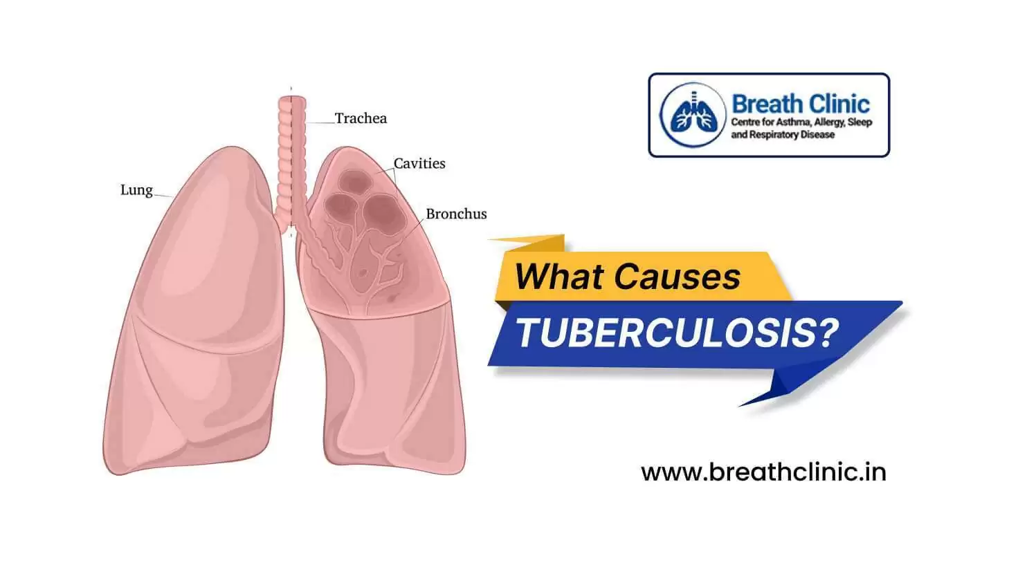Causes tuberculosis